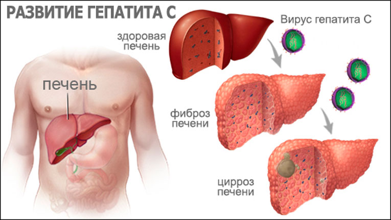 Хронический вирусный гепатит