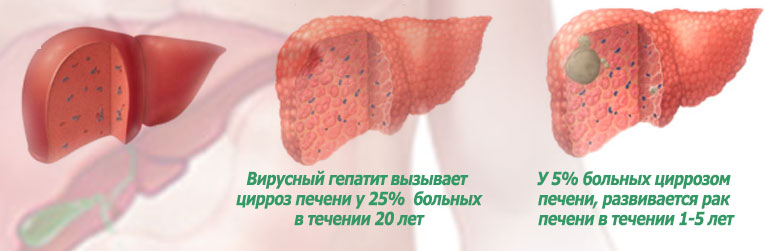 Хронический вирусный гепатит В